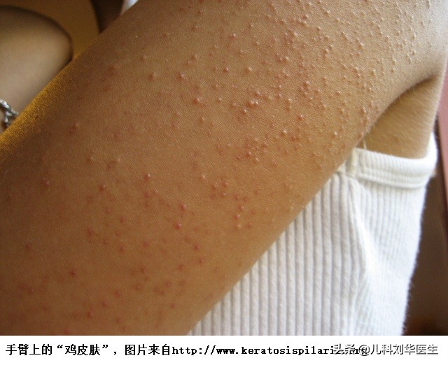 鸡皮状的皮肤病,鸡皮样的疹子是什么病
