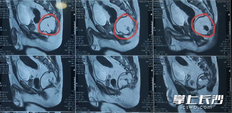 20多岁男子肛瘘怎么回事,患者男45岁因肛瘘入院治疗