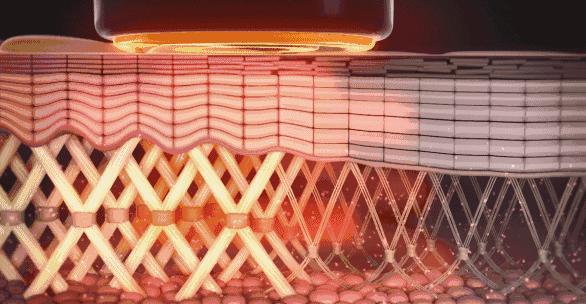 超声炮做了之后脸部有凹陷怎么办,超声炮刚做完脸部凹陷是怎么回事