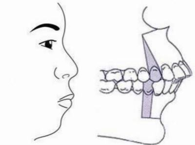 牙齿矫正后反弹了最好挽救办法,牙齿矫正反弹二次矫正收费