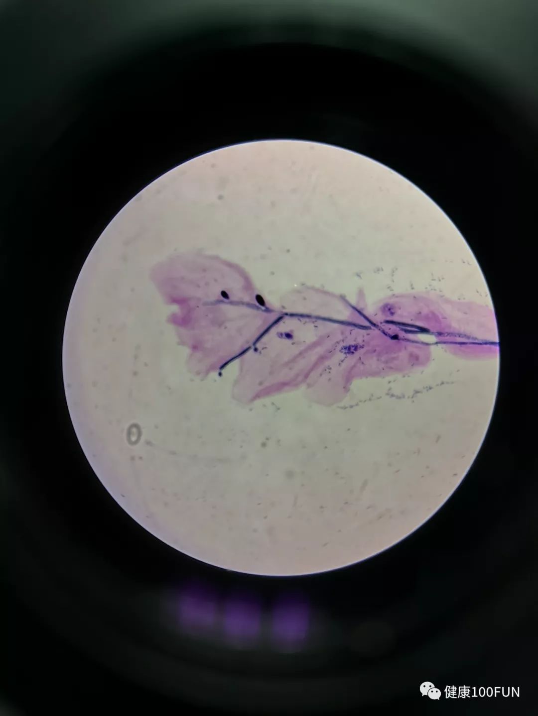 鏈堢粡鏈熷闃翠笉閫忔皵婀跨棐,濡囧コ涓嬮儴婀跨棐鐢ㄤ粈涔堣嵂