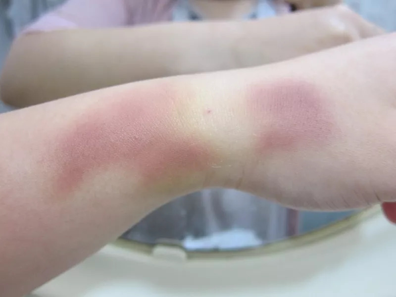 腿上为什么会莫名其妙出现淤青,腿上莫名其妙有淤青按压疼