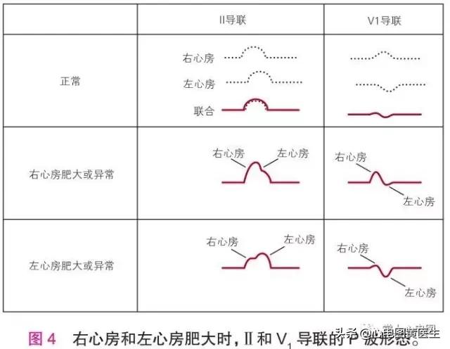 左、右心房肥大/异常「11」