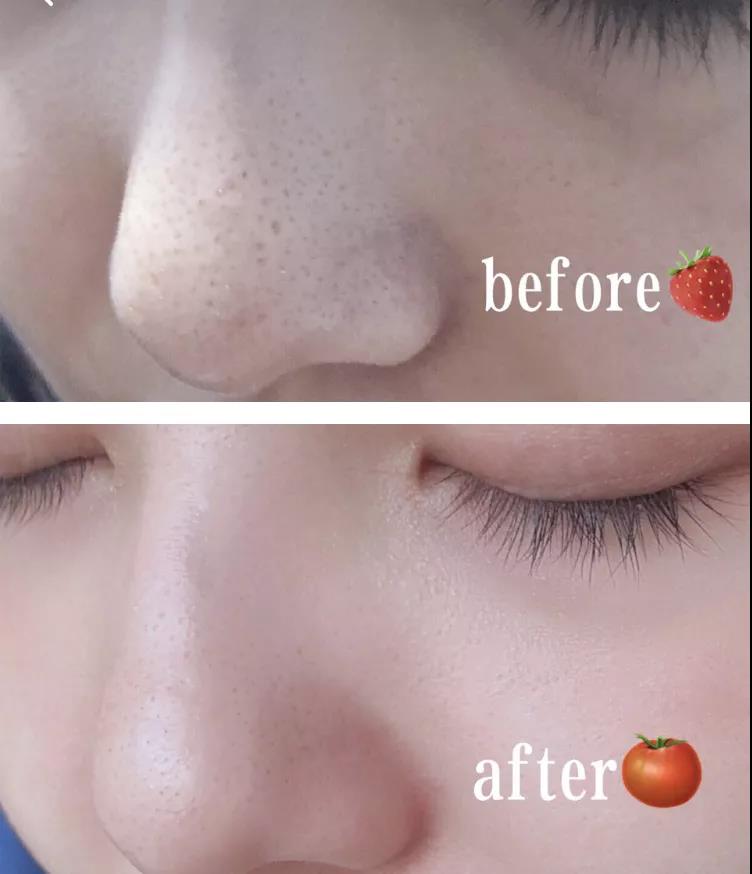 一秒去黑头去粉刺,一步就能搞定的黑头