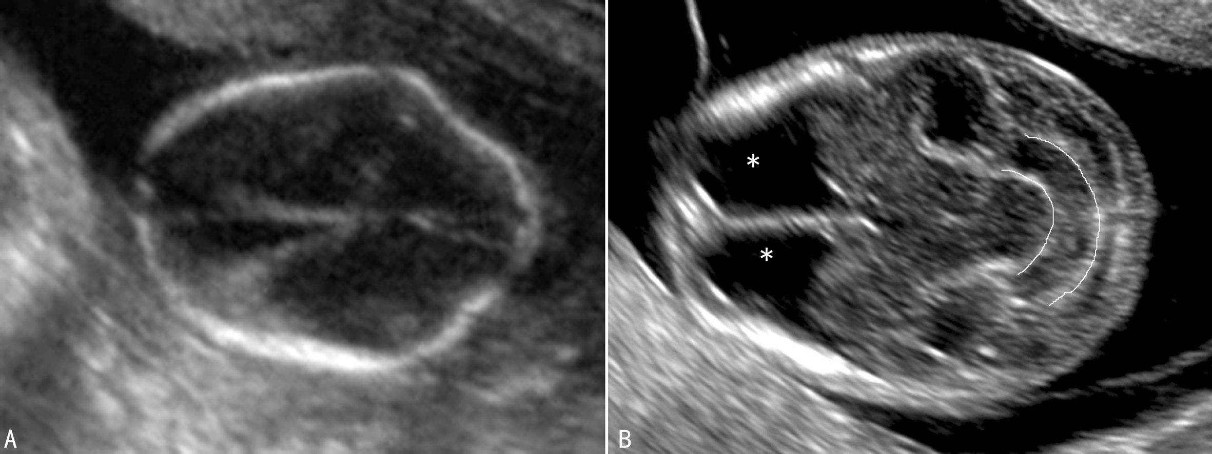 明明白白做超声25-5：胎儿神经管缺陷—脊柱裂