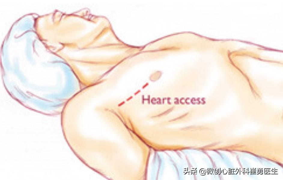 浙江省人民医院做心脏手术如何,浙江人民医院微创心脏手术