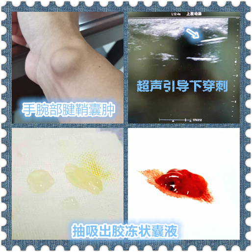 腱鞘囊肿开刀会碰到筋吗,腱鞘囊肿不想去医院自己怎样康复