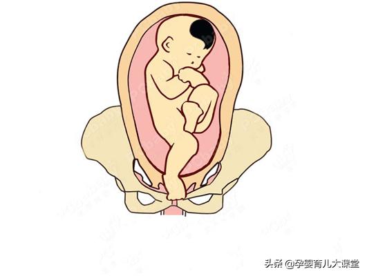 37周脐带绕颈2圈矫正图片胎位不正,孕妇胎位不正的原因及纠正方法