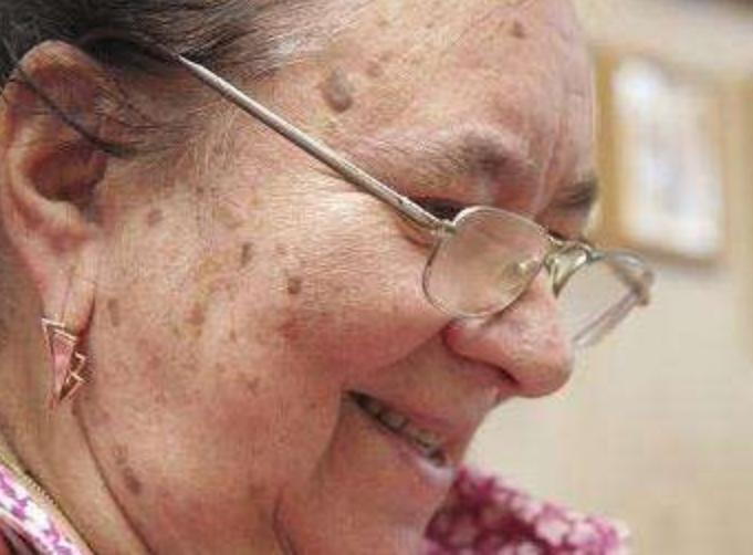 老年斑抓破了会病变吗,经常挖破老年斑会导致癌变吗