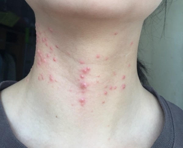脖子上长了很多痘痘什么原因,脖子上长痘痘什么原因及解决办法