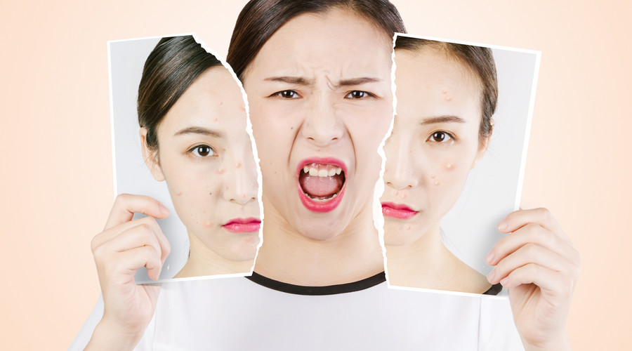 脸上老是长痘痘不得好怎么回事,脸上为什么反反复复长痘痘