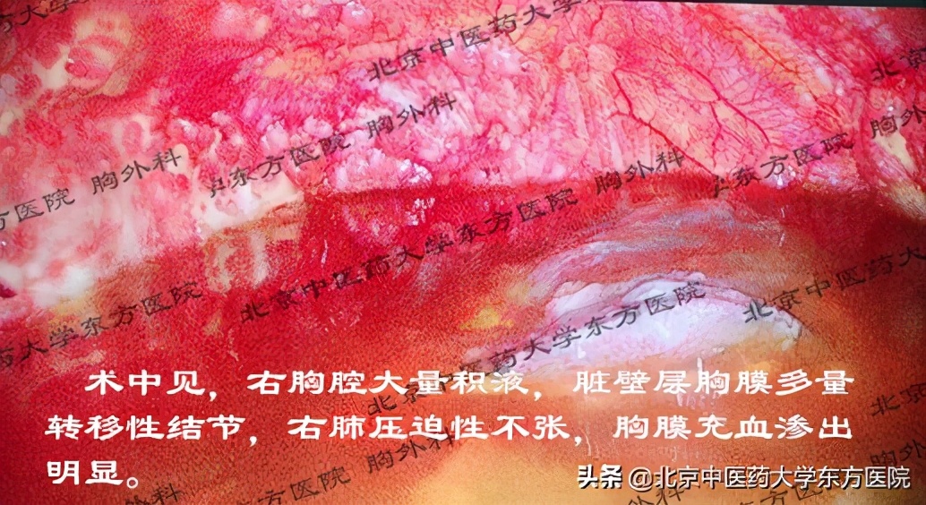 北京治疗胸腔积液哪个医院权威,中医治疗心脏胸腔积液