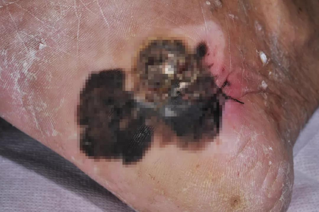 痣用点么,痣能点么