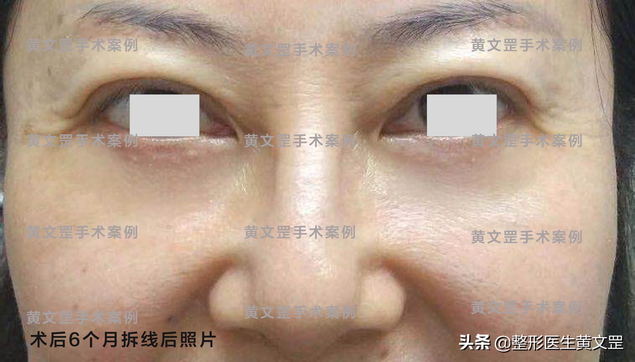 「黄文罡案例」去除眼袋和泪沟，让你年轻10岁