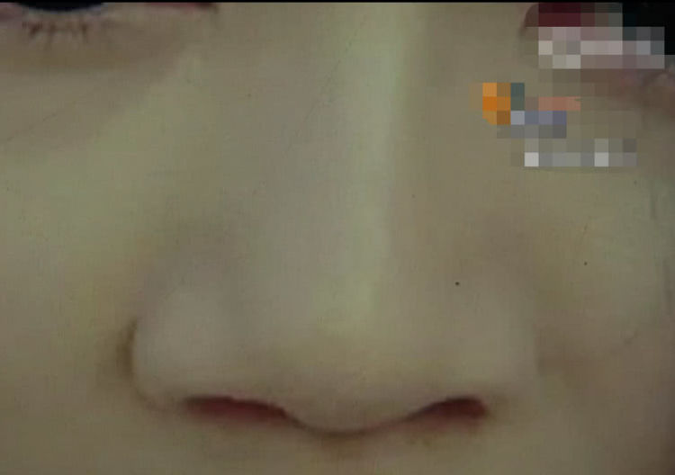 女子鼻子整容失败,女子鼻子整形