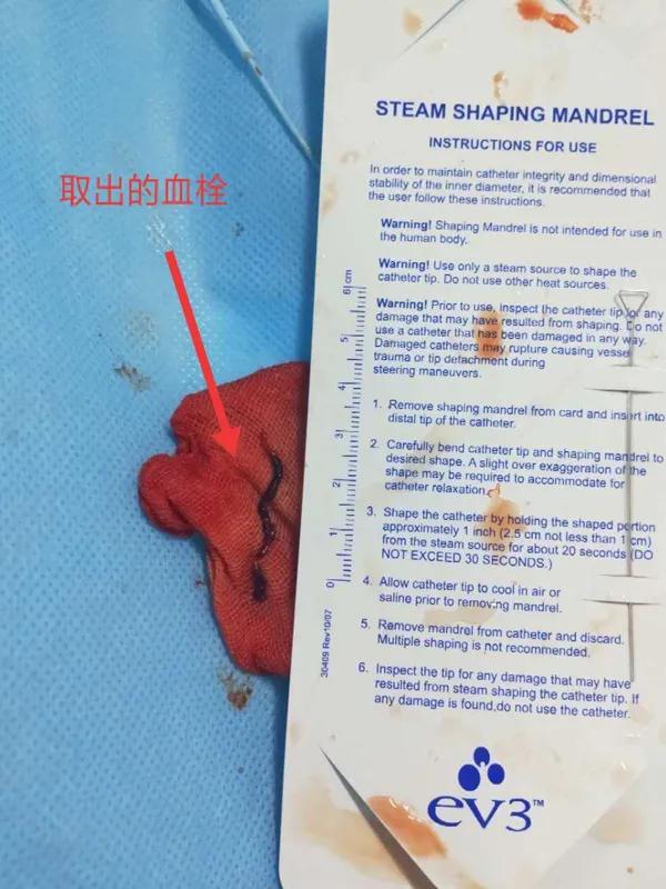 取栓急诊手术,急救92岁老人取栓成功创奇迹