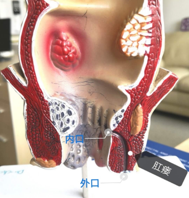 肛瘘手术切口肉挖空了怎么回事,肛瘘手术当天要不要人照顾