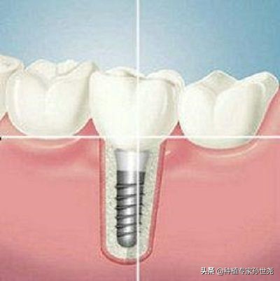 牙齿快烂完了里面疼怎么办,牙槽骨烂了牙齿要拔吗