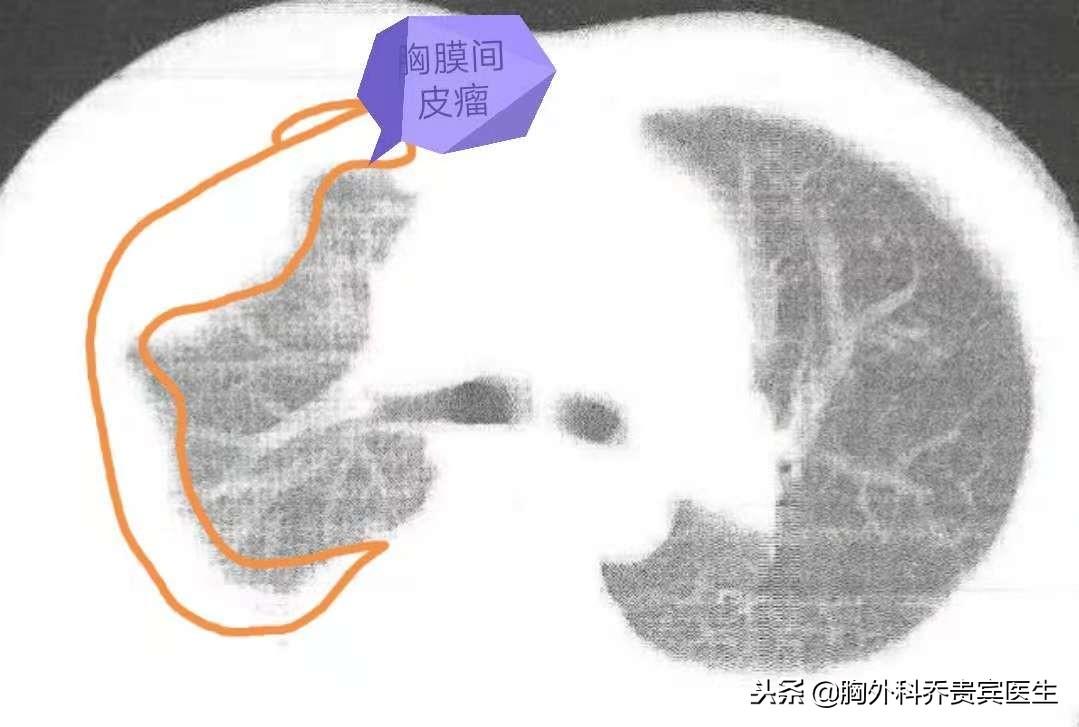 胸膜间皮瘤靶向治疗药,中医治疗胸膜间皮瘤