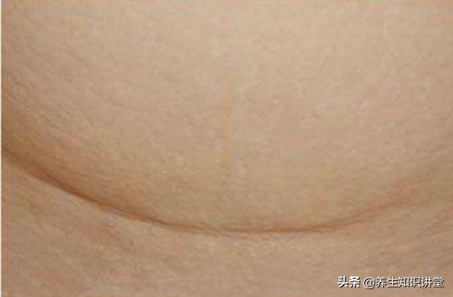 剖腹产疤痕和什么疤痕特别像,同样剖腹产为什么我特别痛
