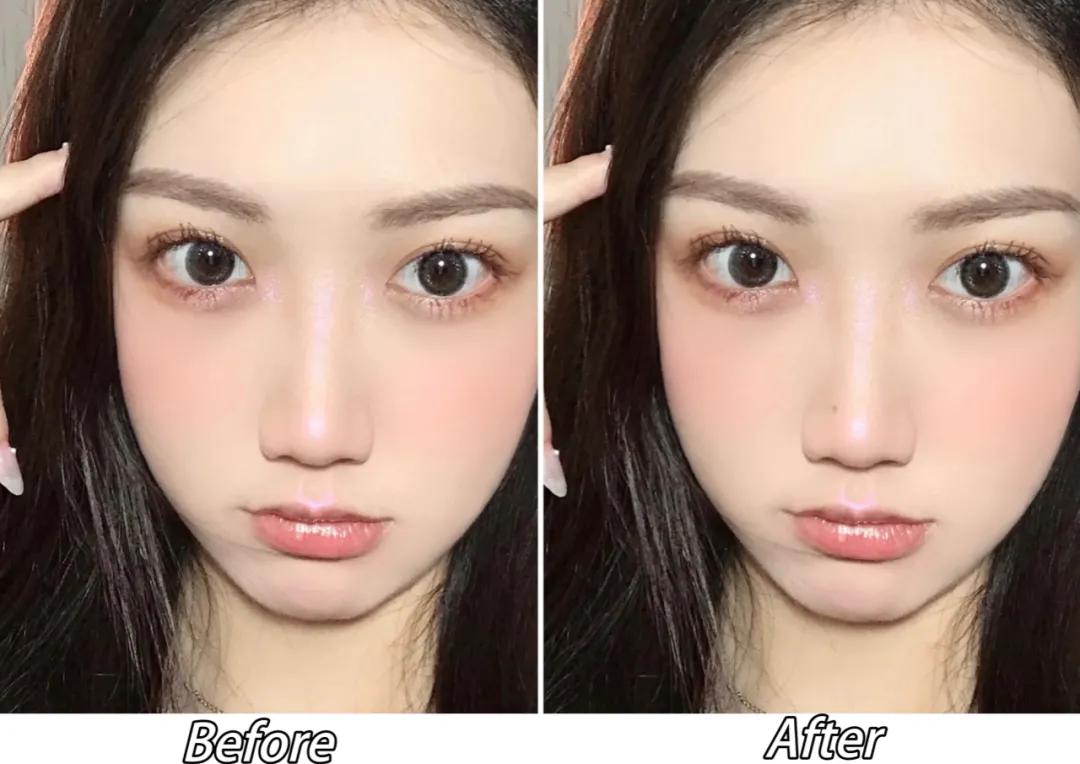 点痣就能变美,点痣整容大法