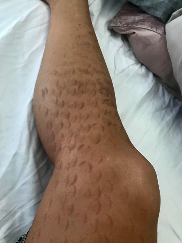 温哥华妹子花7000加币激光脱毛,加拿大女子被烧伤