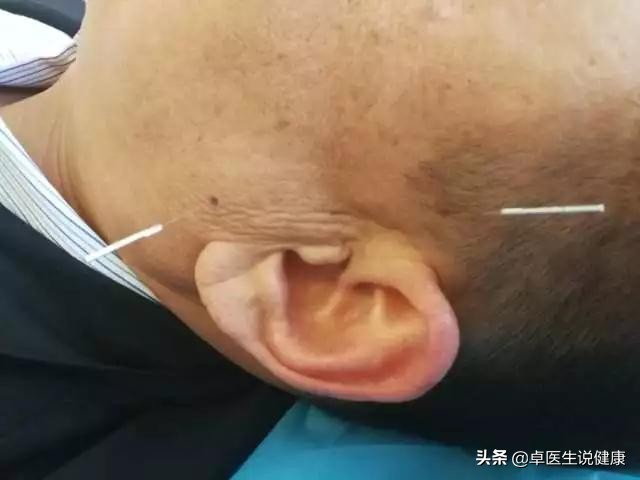 中医眼科飞蚊症验方大全,中医治疗飞蚊症穴位