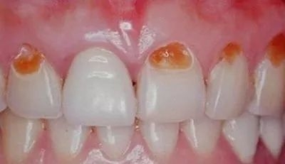 什么是牙齿脱矿原因与疗法你都知道吗？