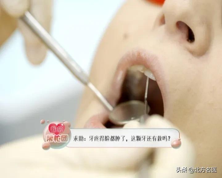 我的帮忙团——牙疼得脸都肿了，这颗牙还有救吗？