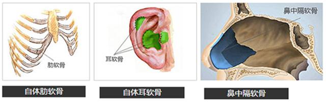 鼻整形案例分享注射隆鼻术,朝天鼻耳软骨假体隆鼻过程