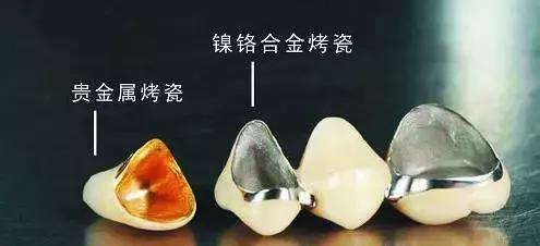 烤瓷牙崩瓷露出里面金属有毒吗,钛合金烤瓷牙有毒吗