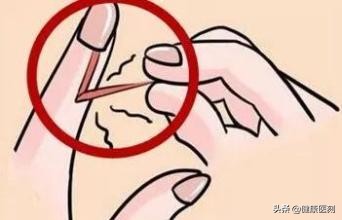 指甲也能剪出错？甲沟炎找上门痛不欲生！这才是剪指甲的正确方式