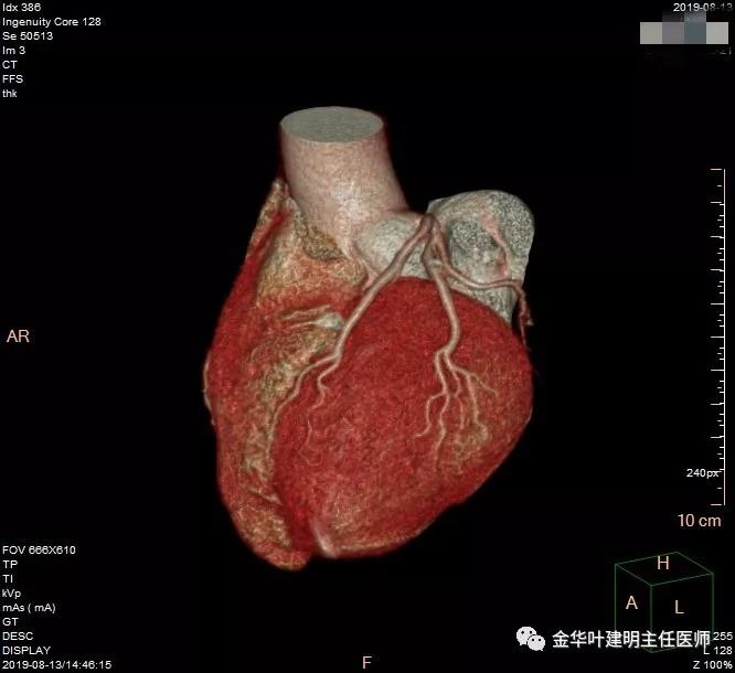 省级医院也漏诊?还好没耽误病情!我们予以行右中下叶袖式切除术