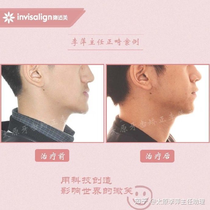 太原矫正牙齿需要做正颌吗,太原牙齿二次矫正