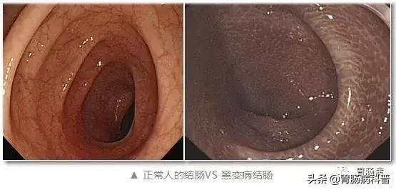 大肠变黑吃什么药好,大肠变黑便秘