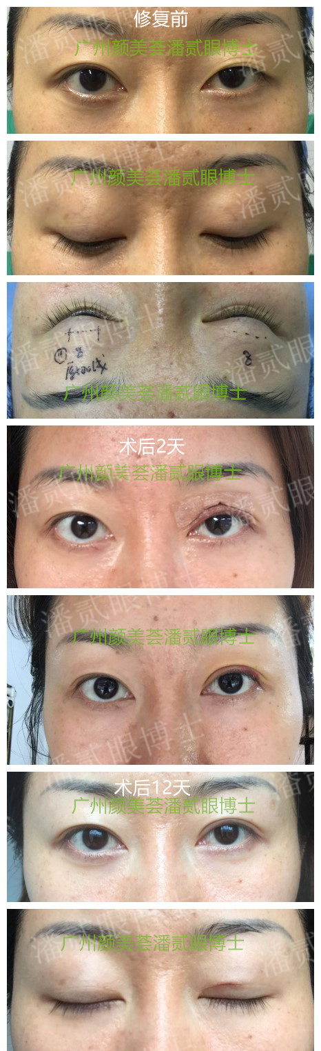 双眼皮太深显老怎么修复,双眼皮失败后修窄