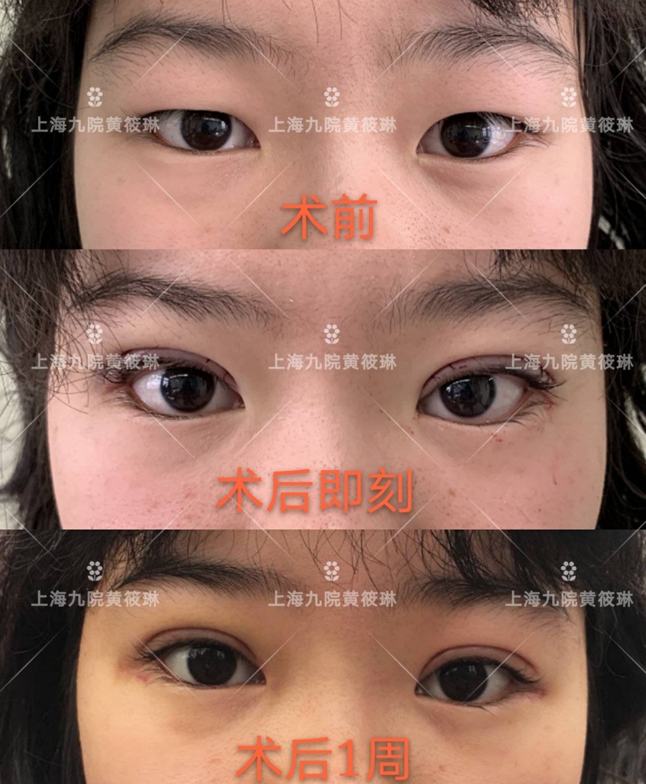 双眼皮消肿以后还是变宽,双眼皮吃什么药消肿比较快