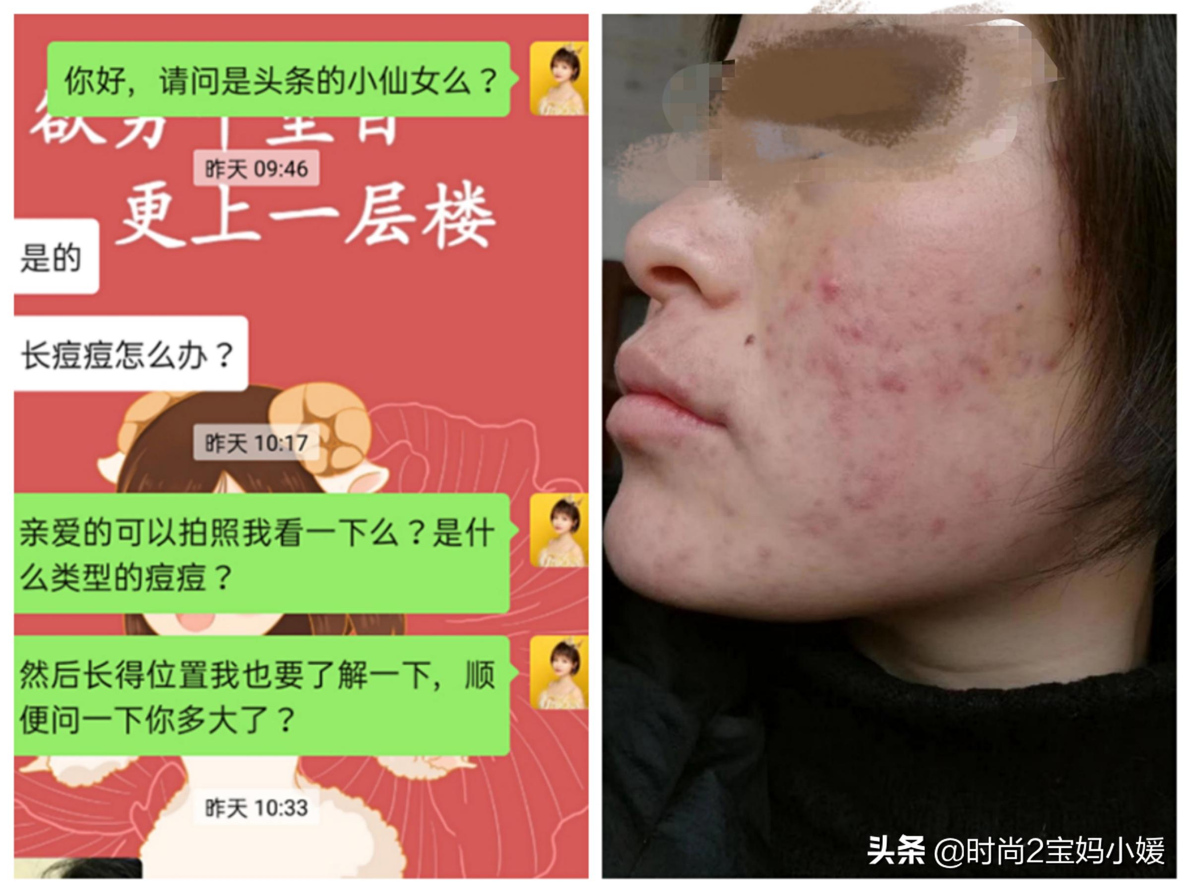 长痘痘不要怕祛痘有良方,长痘痘了该如何消痘不用任何药品