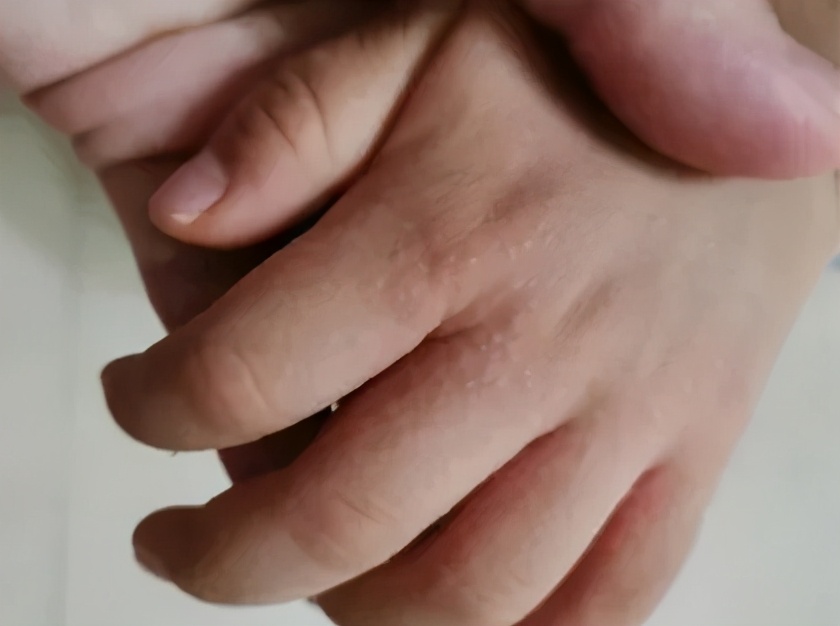 天一热手上就起一层小疙瘩还很痒,两只手上长密集的小疙瘩很痒很红