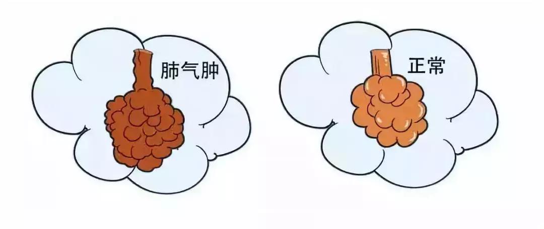 换季慢阻肺气喘怎么办,春季换季咳嗽最快治愈方法