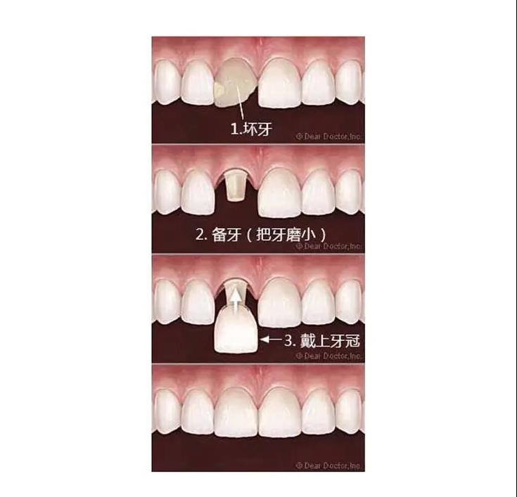 赵薇牙齿做了烤瓷牙吗,吴宣仪牙齿烤瓷牙