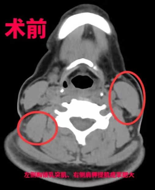 治疗歪脖,治疗脖子歪