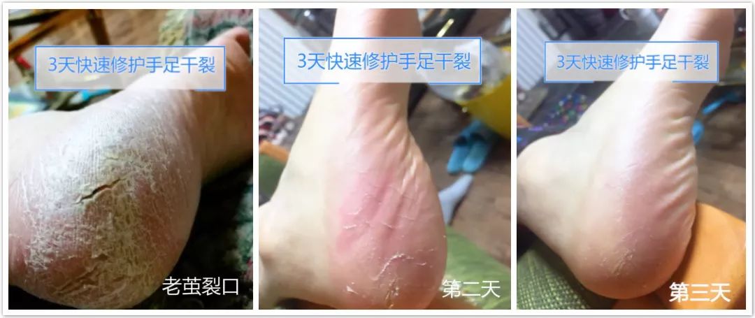 后脚跟干裂护足霜排行榜第一名,护脚霜脚后跟干裂修复霜国货