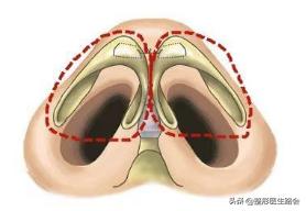 鼻翼缩小鼻骨内推手术,宽鼻头缩窄手术好做吗