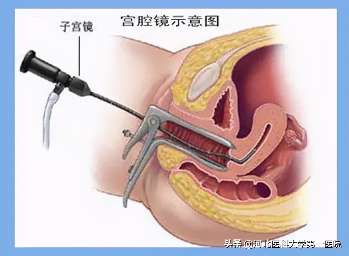 子宫炎症微创手术全过程,切除子宫是微创好还是别的办法好