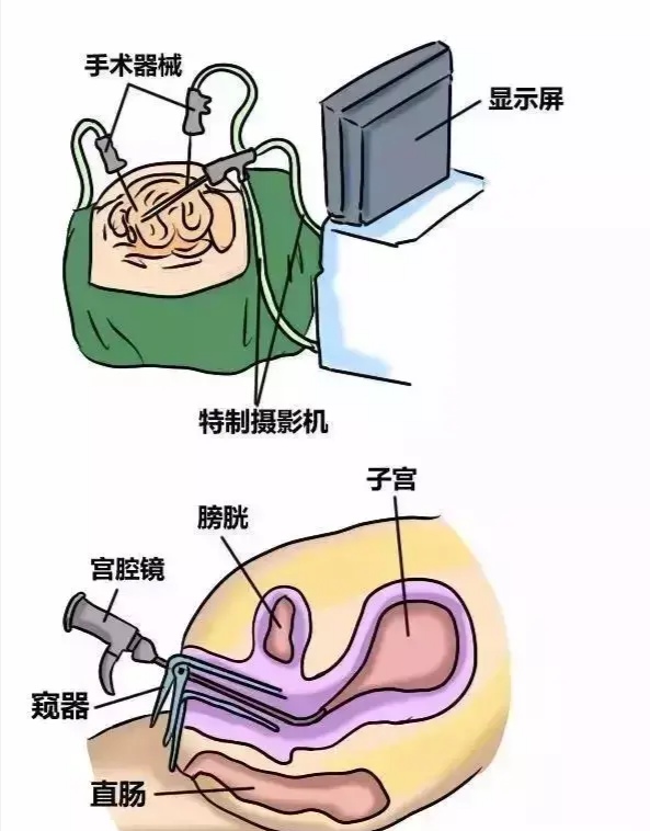 子宫息肉是常见妇科病吗,子宫息肉病因是什么
