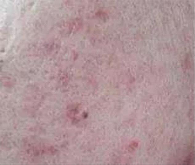 为什么痘印祛不了,为什么痘印去除不了