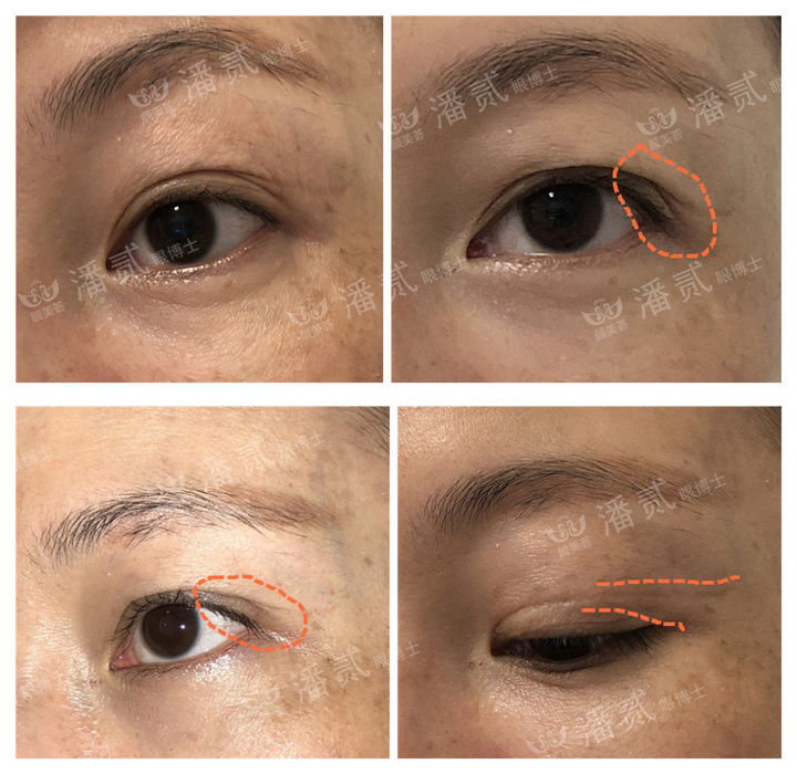 割了开扇双眼皮眼尾上扬太宽,眼尾上扬的眼睛适合什么双眼皮