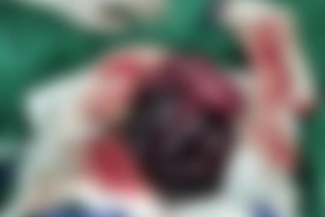 4岁小孩切除150厘米小肠,儿童小肠切除25cm多久能恢复