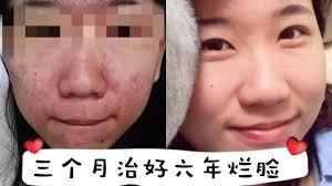 中医后背长痘中成药,背后长痘用什么中药